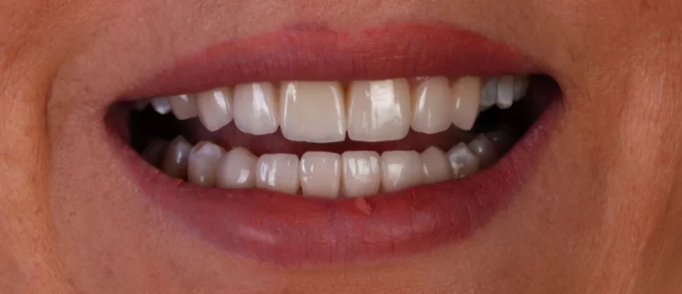 paciente-6-despues-carillas-emax-coronas-zirconio-hollywood smile-estambul-clinicas-dentales