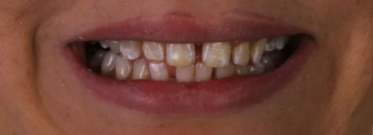 מטופל-6-לפני-ציפוי-emax-כתרים-זירקוניום-הוליווד סמייל-איסטנבול-מרפאות-שיניים