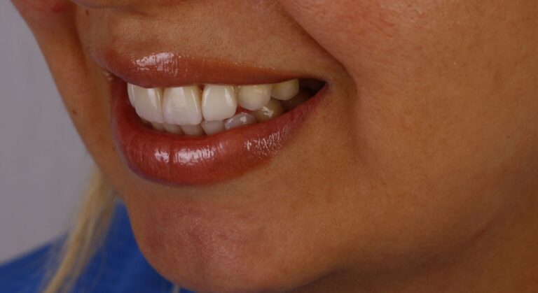 المريض -8-بعد-قشرة-صفح-قشور-يبراك-بورسيلين-إي-ماكس-التيجان-الجمالية-الابتسامة-ديزاين-اسطنبول-عيادات الأسنان