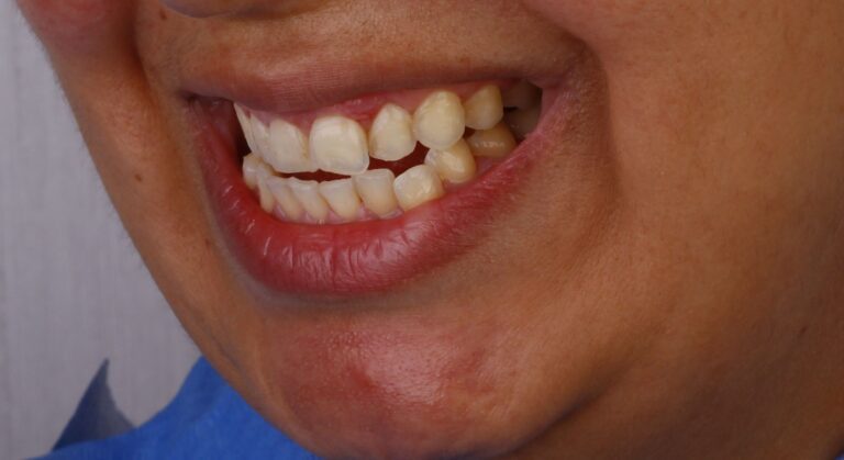 المريض -8-قبل-الفينير-صفح-قشرة-يبراك-بورسيلين-إي-ماكس-التيجان-الجمالية-الابتسامة-ديزاين-اسطنبول-عيادات الأسنان