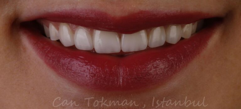 מטופל-9-אחרי-ציפוי-הלבנת שיניים-איסטנבול-מרפאות-שיניים