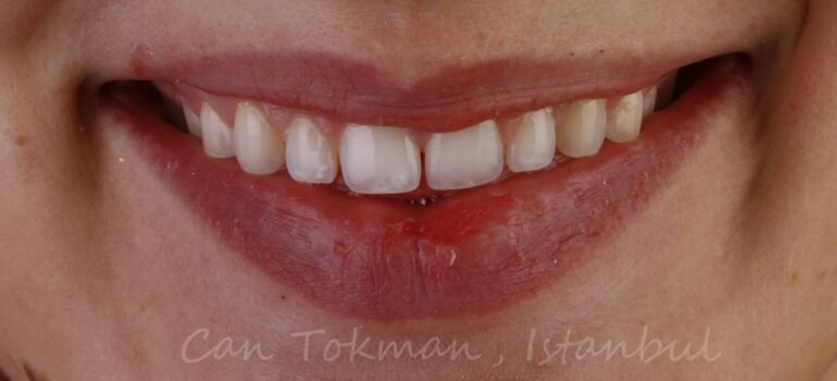 מטופל-9-לפני-ציפוי-הלבנת שיניים-איסטנבול-מרפאות-שיניים