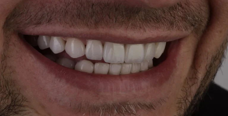 מטופל 7 לאחר ציפוי עיצוב חיוך אסתטי בעוד שבוע במרפאות השיניים באיסטנבול