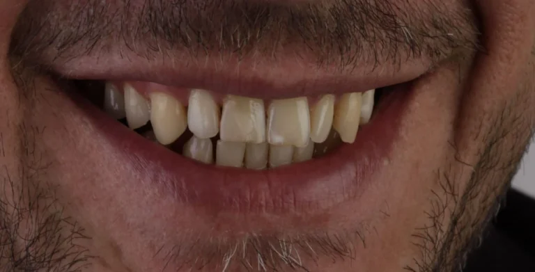 مريض 7 قبل الفينيرز تصميم الابتسامة الجمالية في أسبوع واحد في عيادات طب الأسنان في اسطنبول