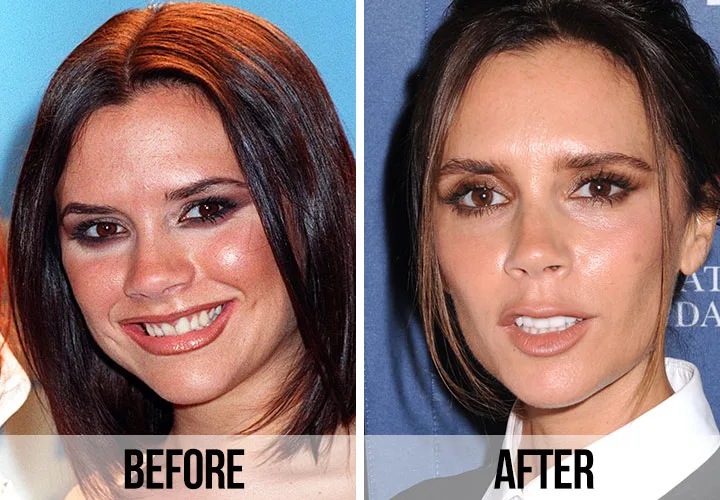 Who Are the Top Celebrities with the Most Iconic Hollywood Smiles? victoria-beckham-hollywood-smile-istanbul-dental-clinics